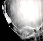 Cochlear Implant Programme