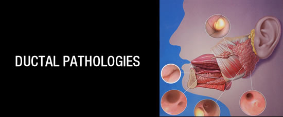 Ductal Pathologies Ductal Pathologies