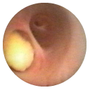 Ductal Pathologies Ductal Pathologies